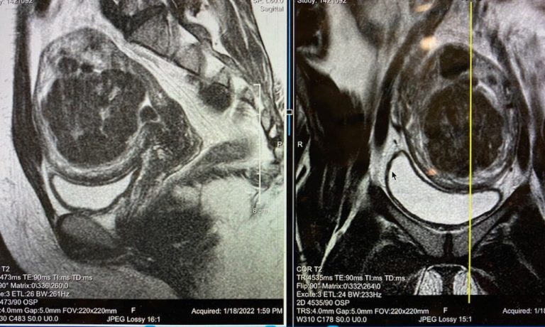 Real Pictures Of Fibroids Mri Ultrasound Images Pics