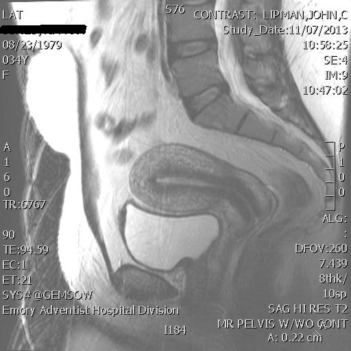 MRI image of the healthy uterus