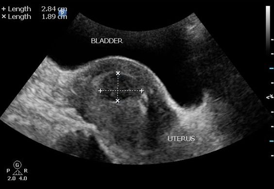 A pelvic ultrasound image of fibroids