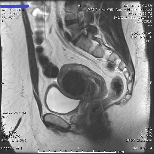 A pelvic MRI image of fibroids