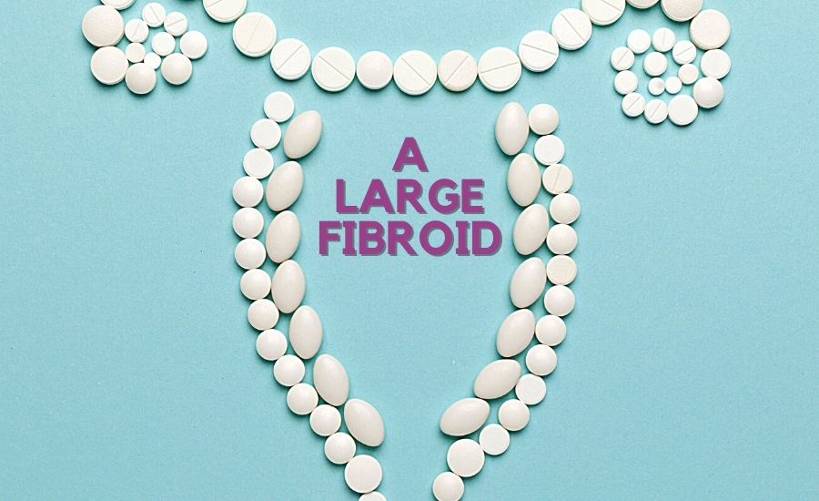 what-is-considered-a-large-fibroid-fibroid-size-chart