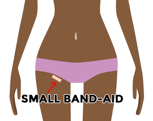 The incision after UFE is shorter than an inch and can be covered with a band-aid.