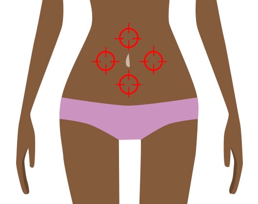  Laparoscopic fibroid surgery creates 3-4 incisions 2-inches long total.
