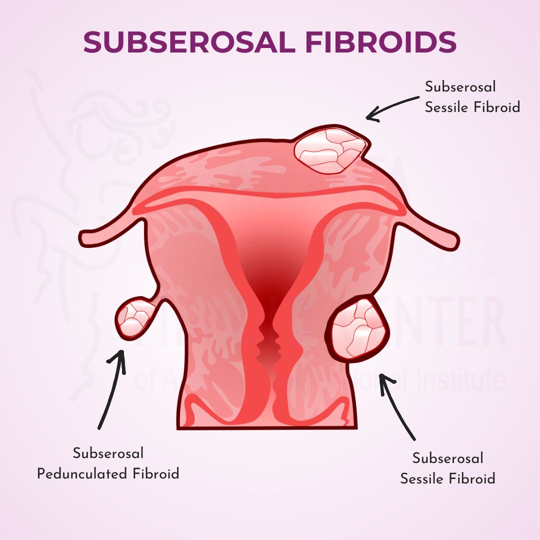 Subserosal fibroids