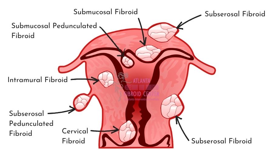 Types of uterine fibroids: submucosal, subserosal, intramural, and cervical
