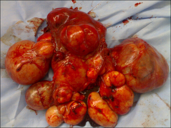 A hysterectomy specimen in a patient who underwent surgery for symptomatic uterine fibroids