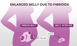 Fibroid belly