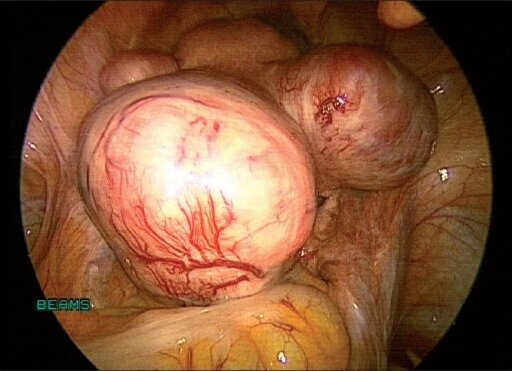Multiple fibroids before devascularisation