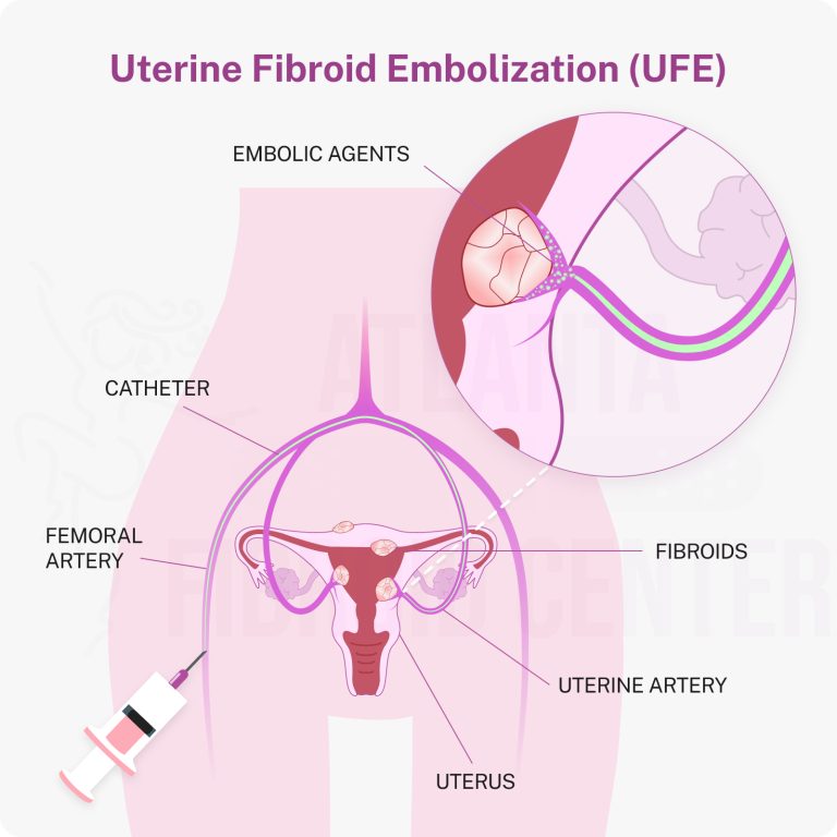 UFE process