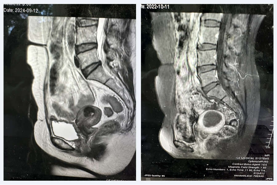 MRI scan of the pelvis
