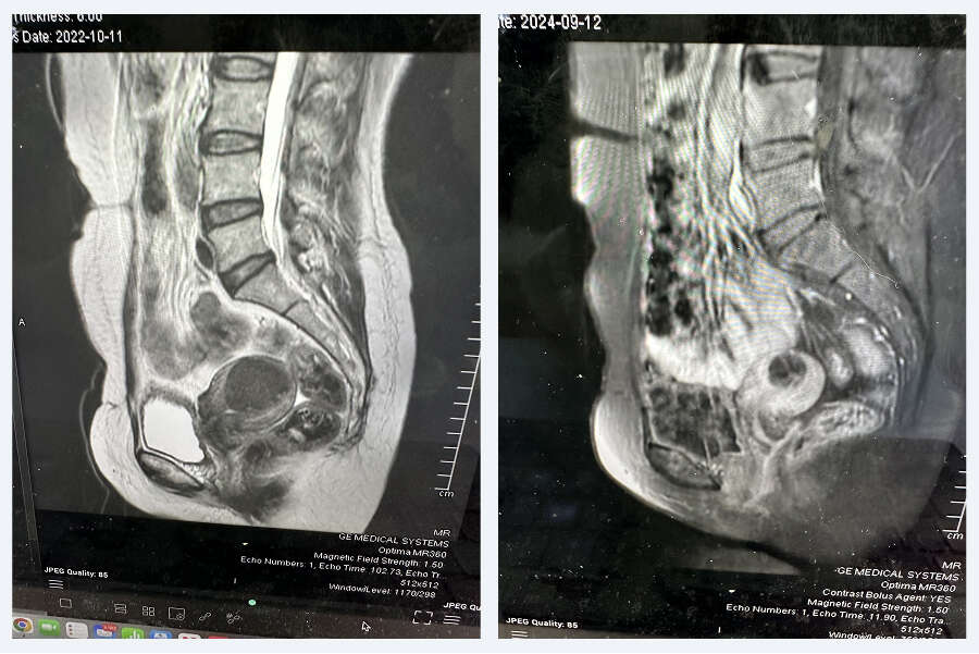 MRI scan of the pelvis
