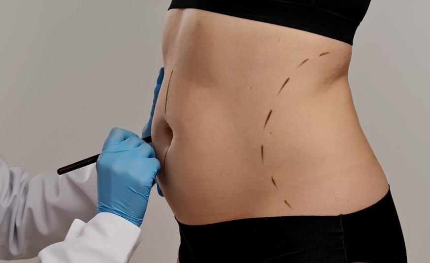 Can You Get Lipo or a Tummy Tuck With Fibroids?