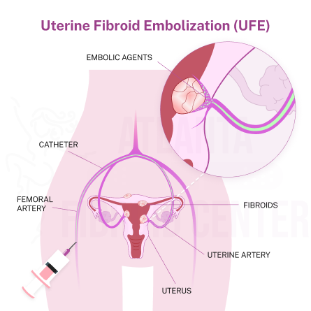 Uterine fibroid embolization (UFE)